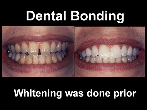 Dental Bonding 4