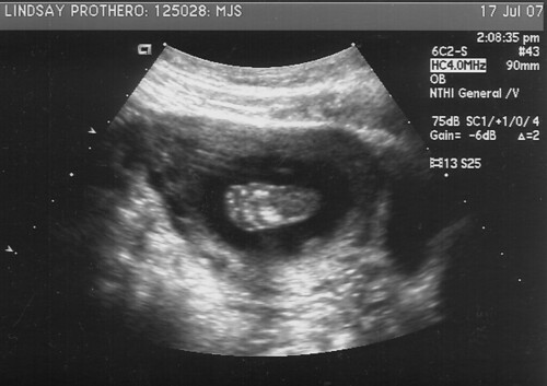 July 17th Ultrasound - foot