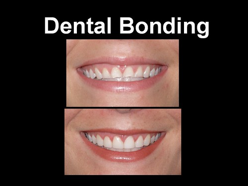 Dental Bonding 9.3