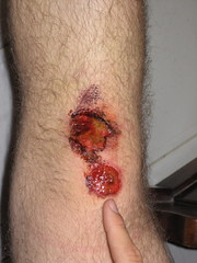 Hole in knee