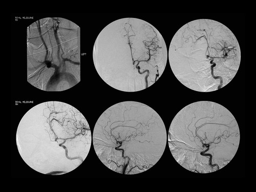 aneurysm clips. DSA of a berry aneurysm