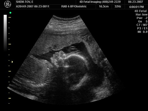 3d ultrasound pictures of twins. 2010 3d Ultrasound Of Twins 3d