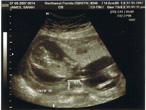 ultrasounds at 13 weeks. KidB @ 13 Weeks