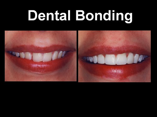 Dental Bonding 3