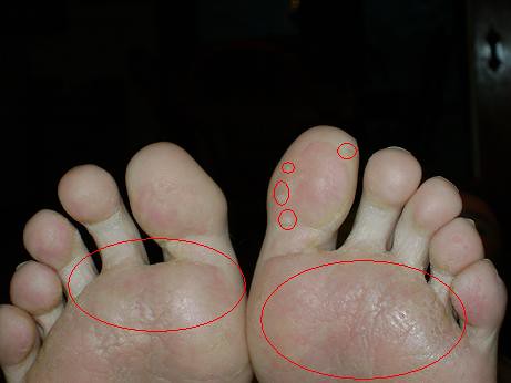 tiny holes on bottom of feet - pictures, photos