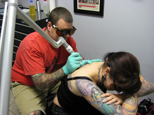 tattoo removal los angelesThere is a permanent tattoo permanent 