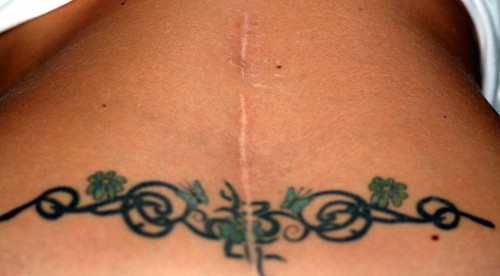 tattoo scars. Scar and Tattoo