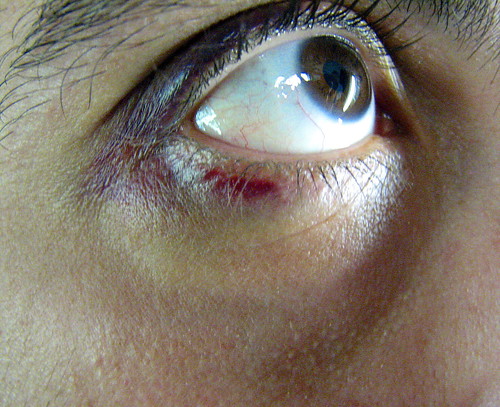 Bruised eye (2)