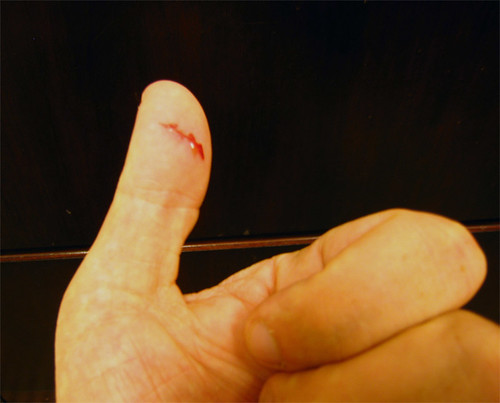 Thumb Injury