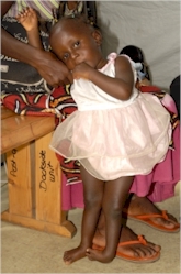 Cynthia - one of the orthopedic patients with a club foot