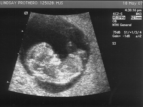 May 18th Ultrasound