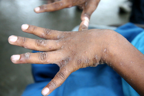 scabies on hands. scabies on hands. Untitled middot; Hands With Scabies