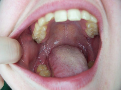 Tooth gum through of poking Bone Poking