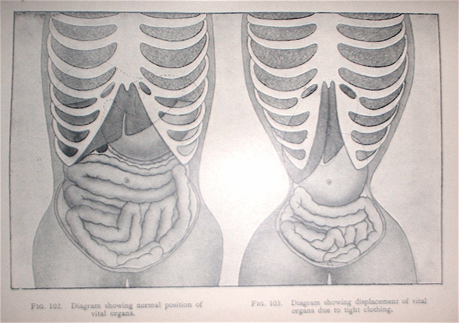 separated stomach muscles. The chest cavity is separated