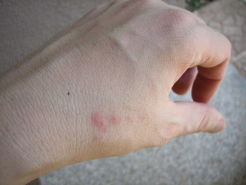 bed bug bites photos. Bed bug bite first day