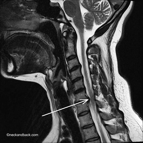 What are the causes of bulging disks in the neck?