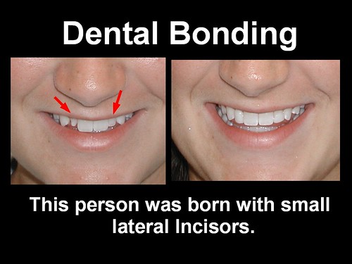 This person couldn't stop smiling after this was done. Dental Bonding 9