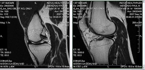 MRI Scan Right Knee