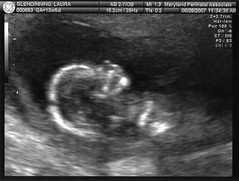 Sonogram image of baby's profile