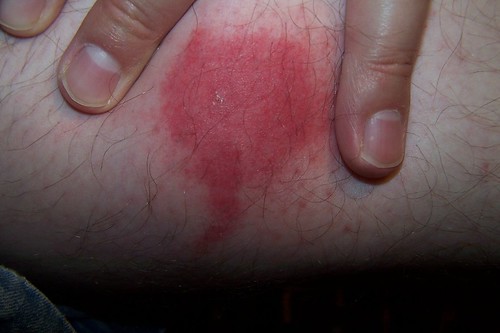 spider bites symptoms and pictures. spider bite symptoms and