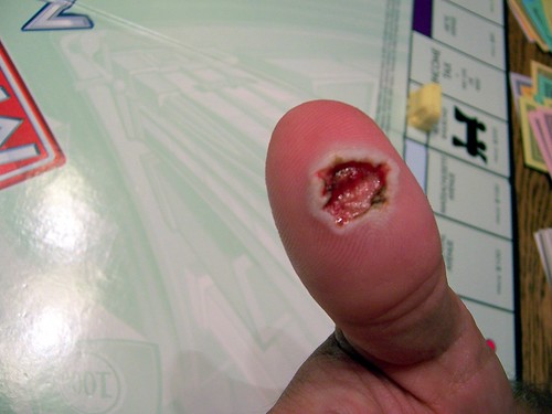 Warts On Fingers. wart removal