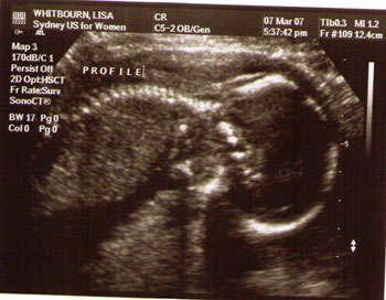 20 week ultrasound of baby #2