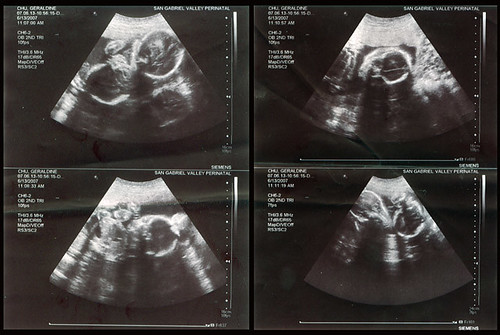 Scans Of Twins. june 13, 2007 - ultrasound scans of the twins. babies @ 23 weeks