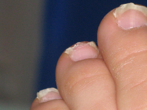 How+to+use+vicks+vapor+rub+for+toenail+fungus