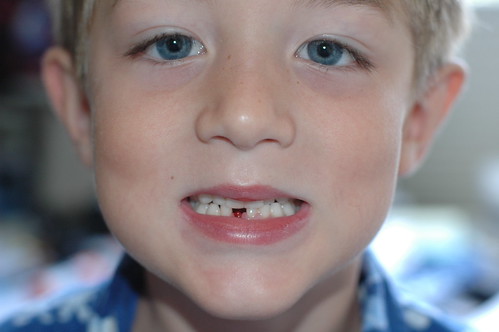lost tooth!