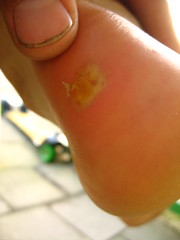 A blister from pusing against the wind - nothing massive, but very painful with shoes on