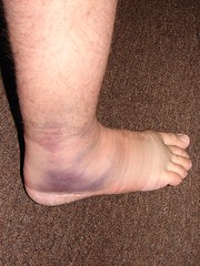 the nasty rolled ankle 1