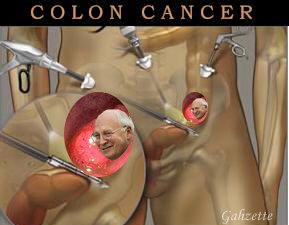 Colon Cancer Dick Head