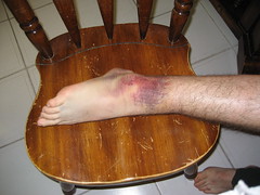 bad ankle