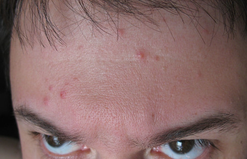 My recent stress has manifested itself as forehead zits!