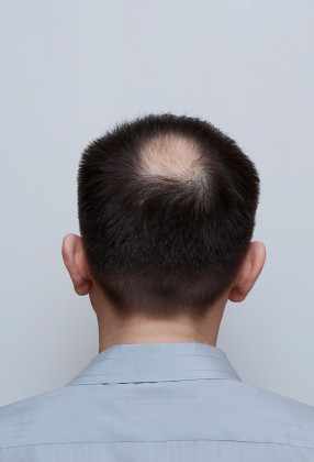 Premature Hair Loss by Webbloke