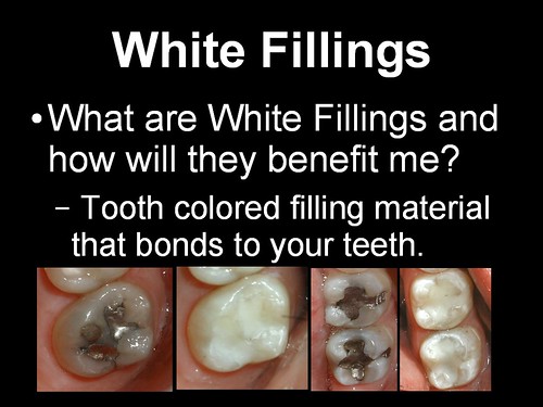 fillings vs silver teeth cavities getting filled dentistry independence mo