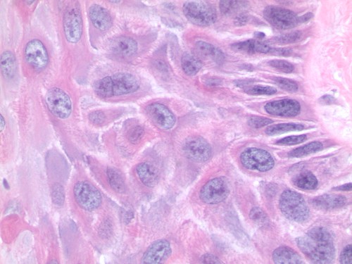 Vulval intraepithelial neoplasia (VIN) - Vulval Pain Society