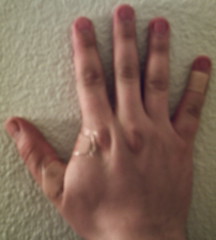 Damaged hand