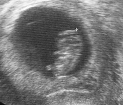 9-week ultrasound