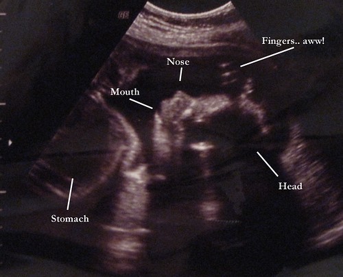 Peanut's Ultrasound