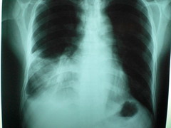 Anglų lietuvių žodynas. Žodis lobar pneumonia reiškia lobar plaučių uždegimas lietuviškai.