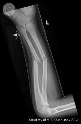 724.2 - fore arm fracture 2